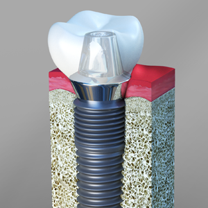 Dental Implants Clark, Garwood, Cranford, Winfield, Colonia, Rahway, Kenilworth, Scotch Plains, Linden